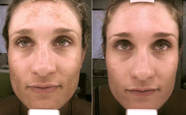 Ultraceuticals peel result