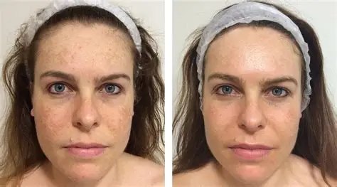 Ultraceuticals peel before and after