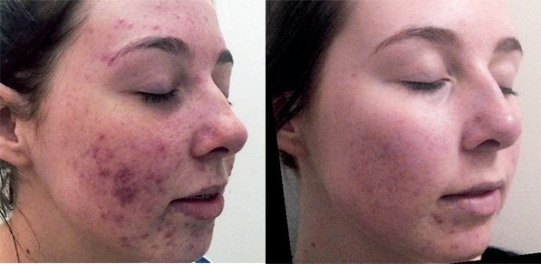 Ultraceuticals peel before and after