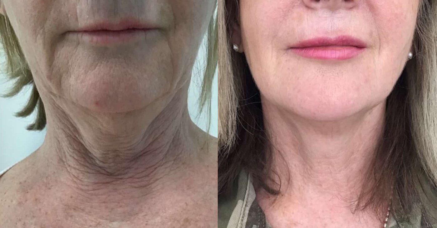 Ulfit HIFU jowl lift before and after at Maison Montclair